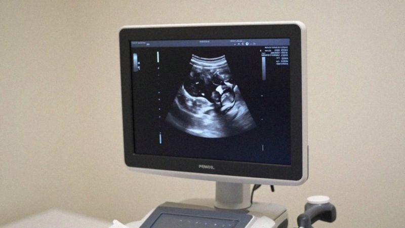 Jakie markery USG sugerują agenezję ciałka modzelowatego?